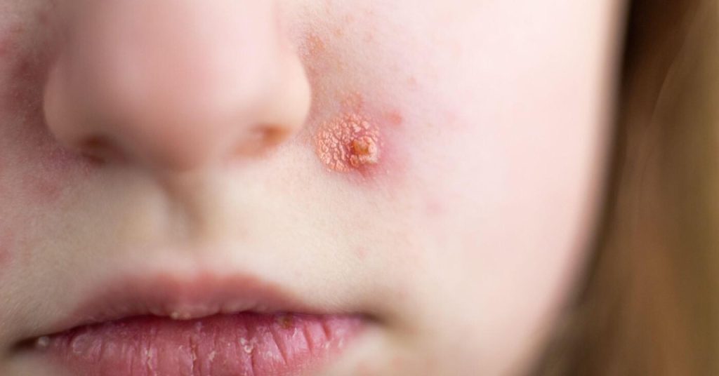 Ljekari upozoravaju: Impetigo se češće javlja tokom ljeta na Jadranu – najugroženija su mala djeca
